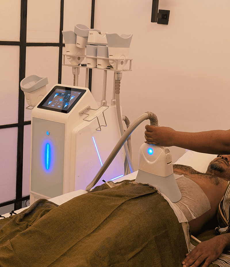 Cryolipolysis (360° Fat Freezing)